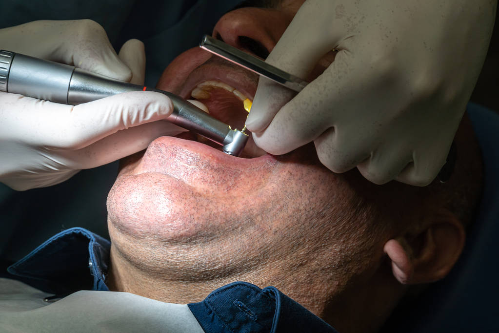 Professional dentist surgeon's hands placing a dental implant